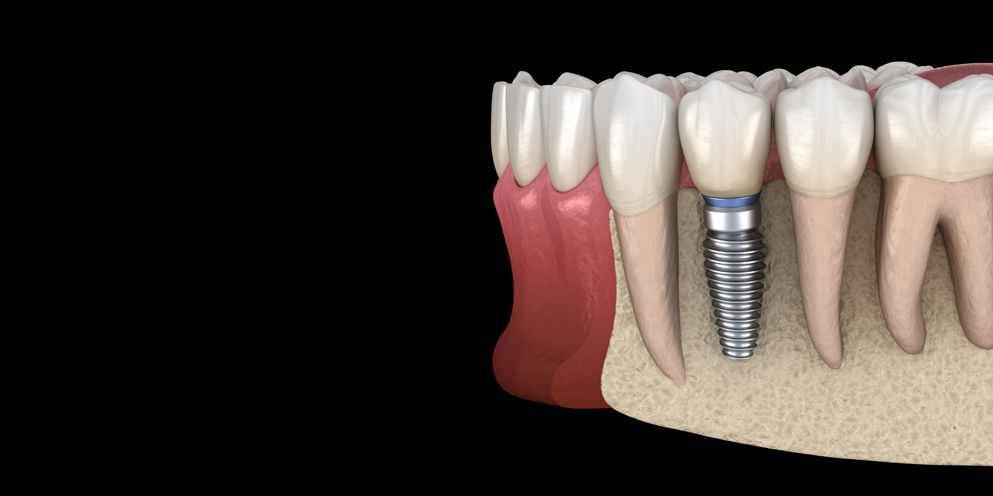 bone graft for dental implants