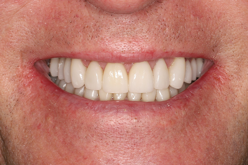 after fmx implants