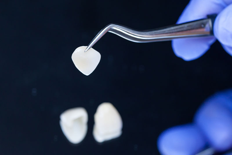 dental veneer held with tool