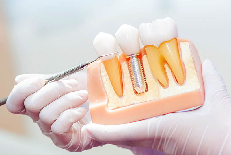 dental implant model real