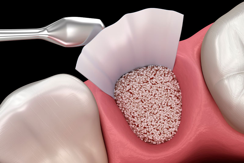 bone graft 3d