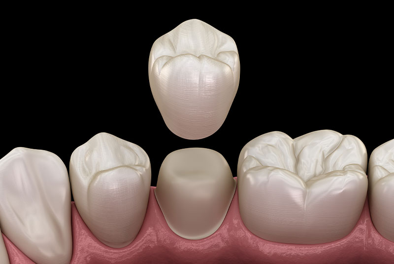 Porcelain Crowns