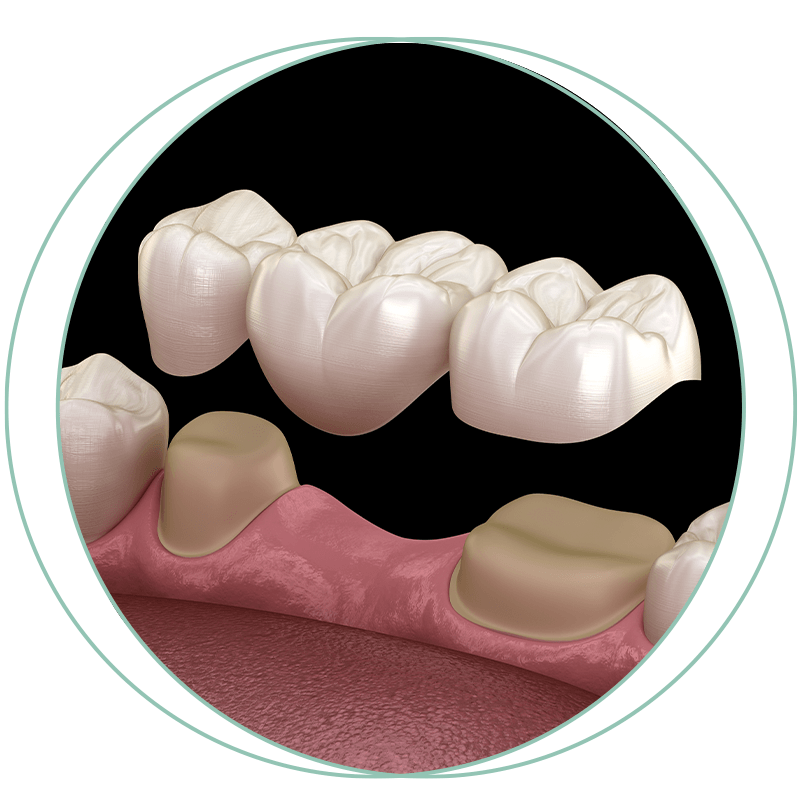 dental bridge 3d