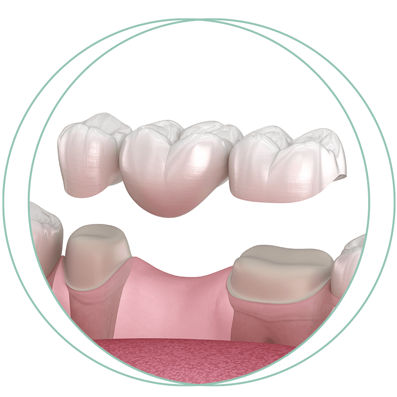 dental bridge 3d