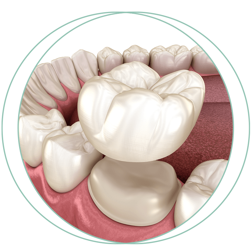 dental crown 3d