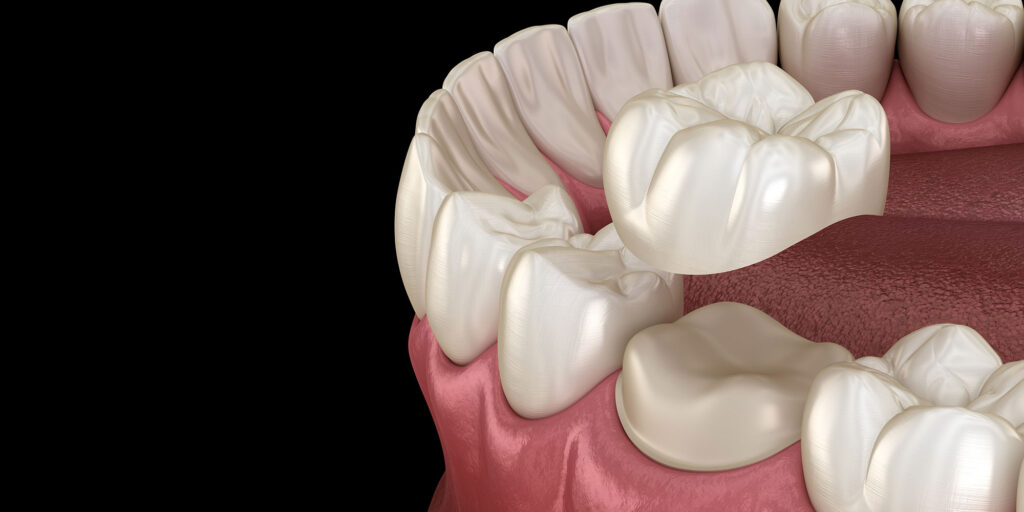 dental crown 3d
