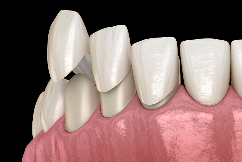 Porcelain Veneers