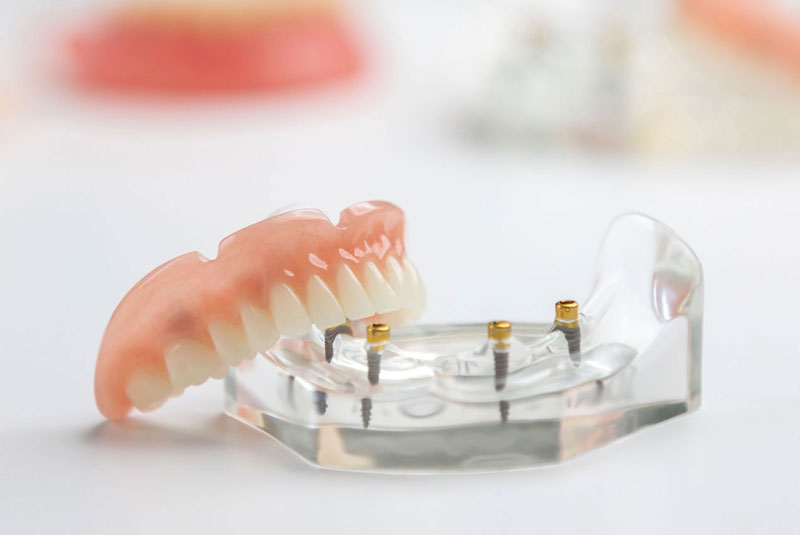 implant denture model