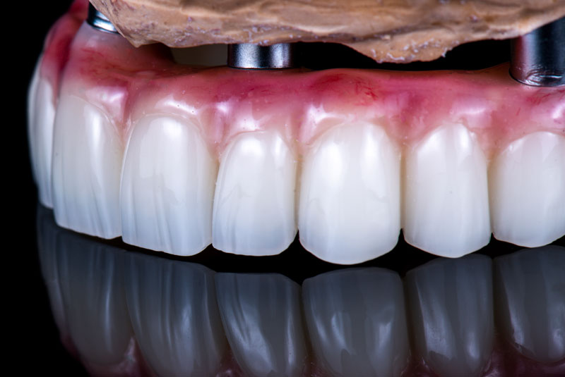 Full-Arch Restorations