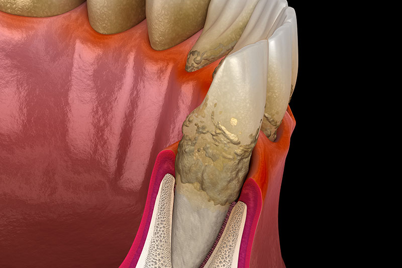 gum disease 3d