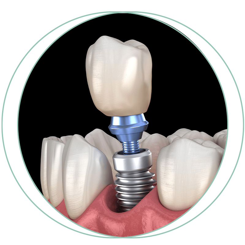 3d implant