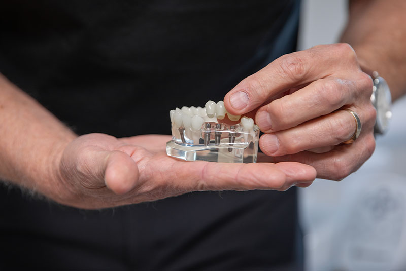 implant bridge model