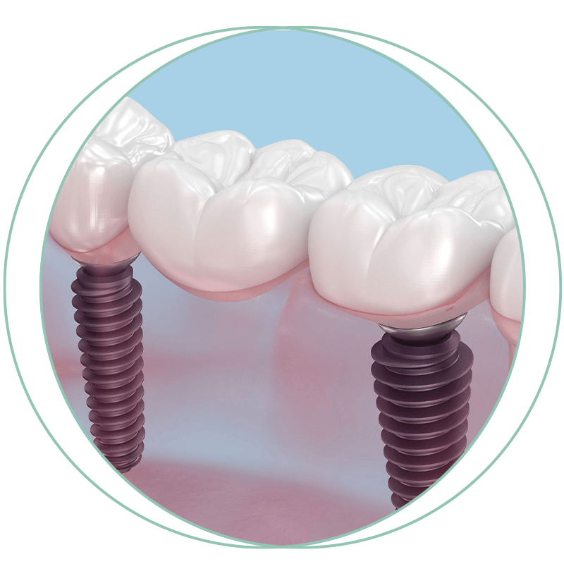 implant bridge 3d
