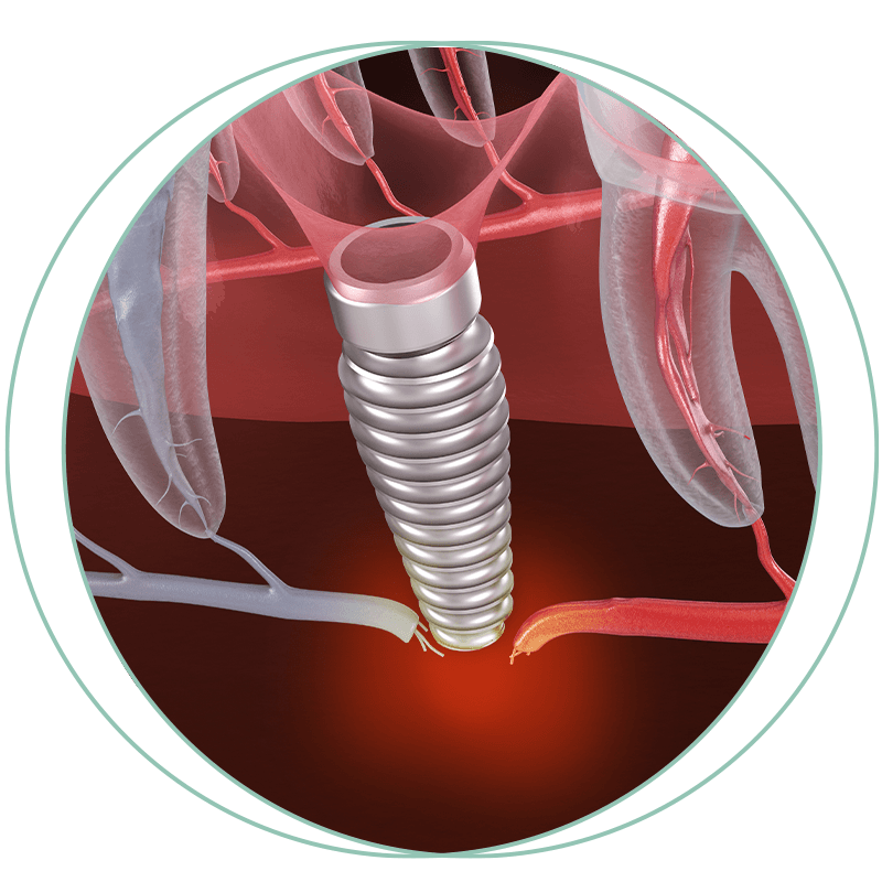 implant failing