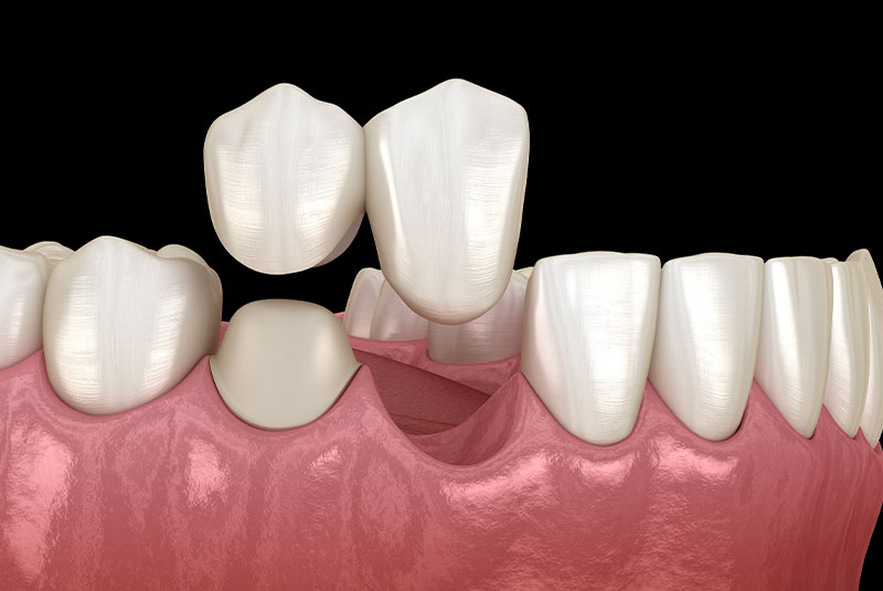 partial dental bridge