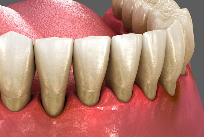 Periodontal Therapy