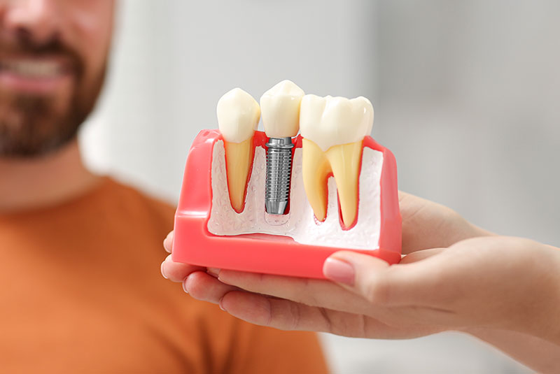 dental implant model