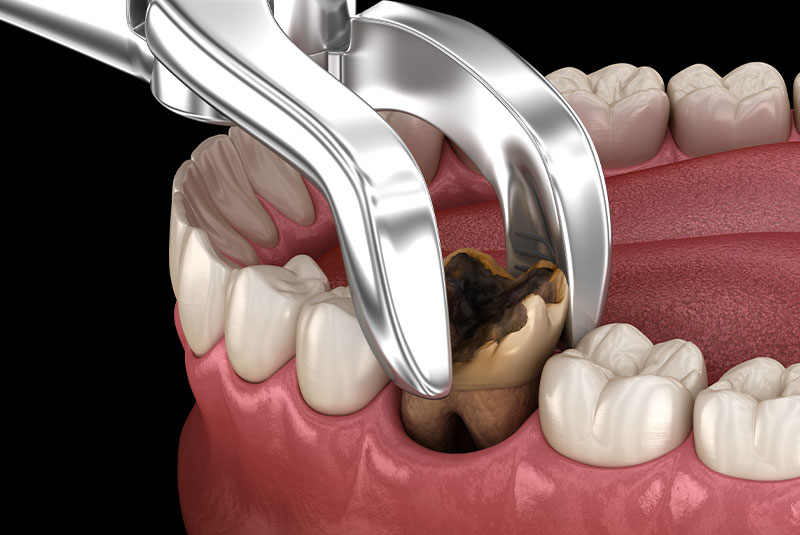 tooth extraction 3d