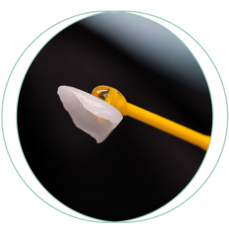 dental veneer being placed